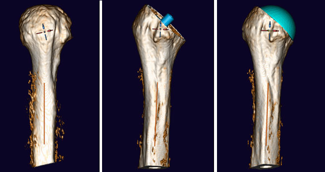 Präzise Segmentierung des Humerus