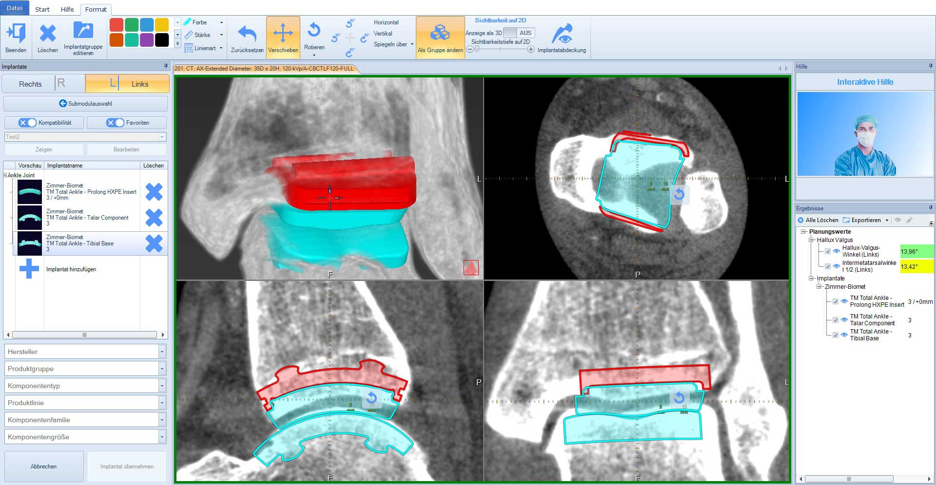 Implantate für den Fuß planen mit mediCAD 3D Foot