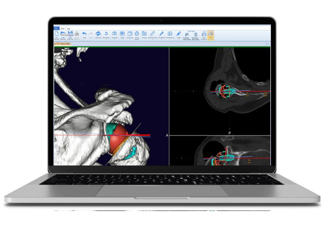 3D Shoulder pre-operative planning software